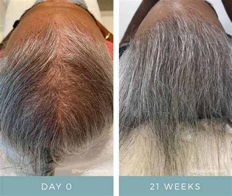 Hair Loss – Lavishette.
